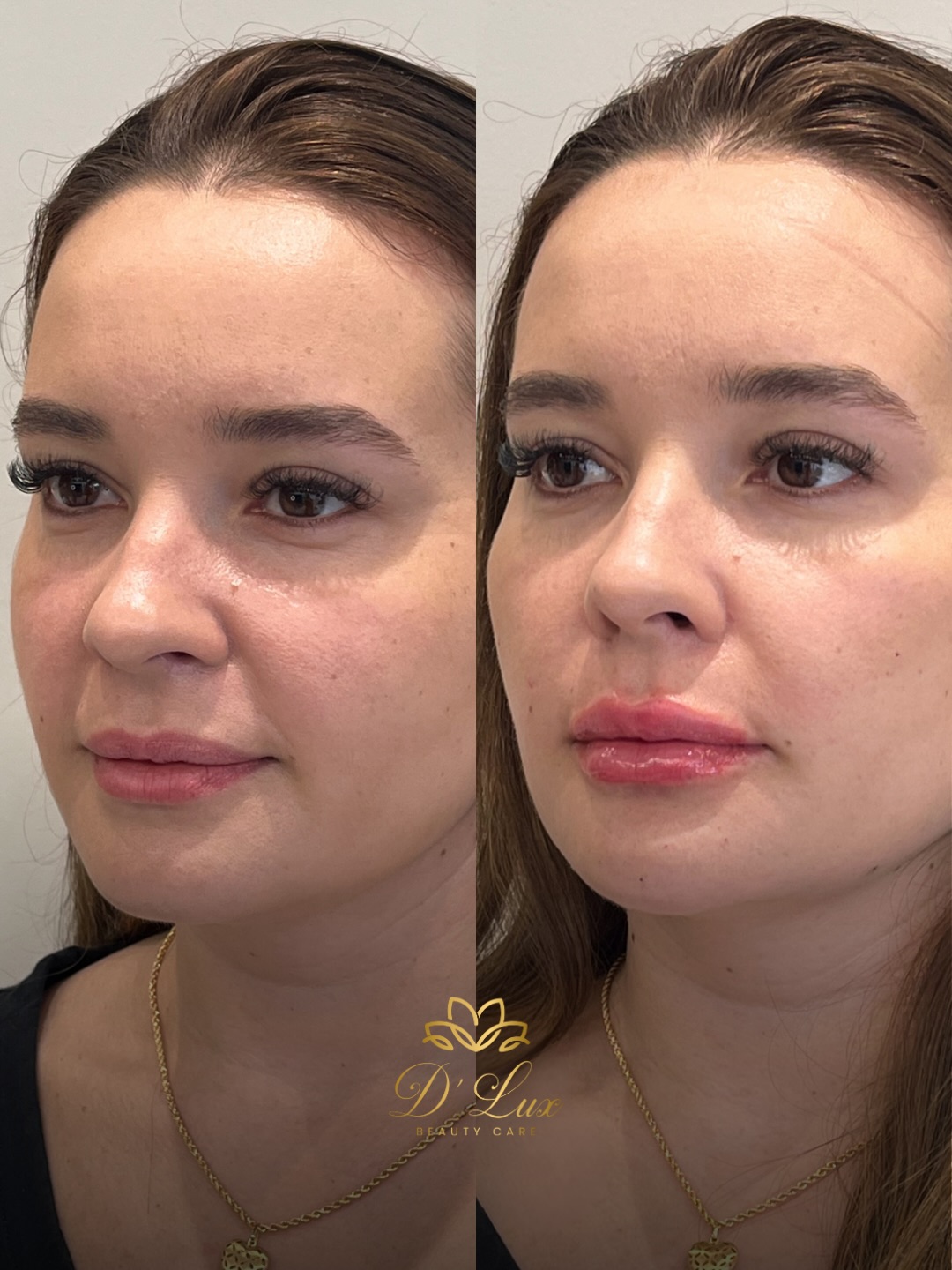 Caso real D'Lux, Harmonização facial